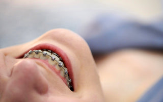 7 Reasons Why Your Dental Braces Are Still On
