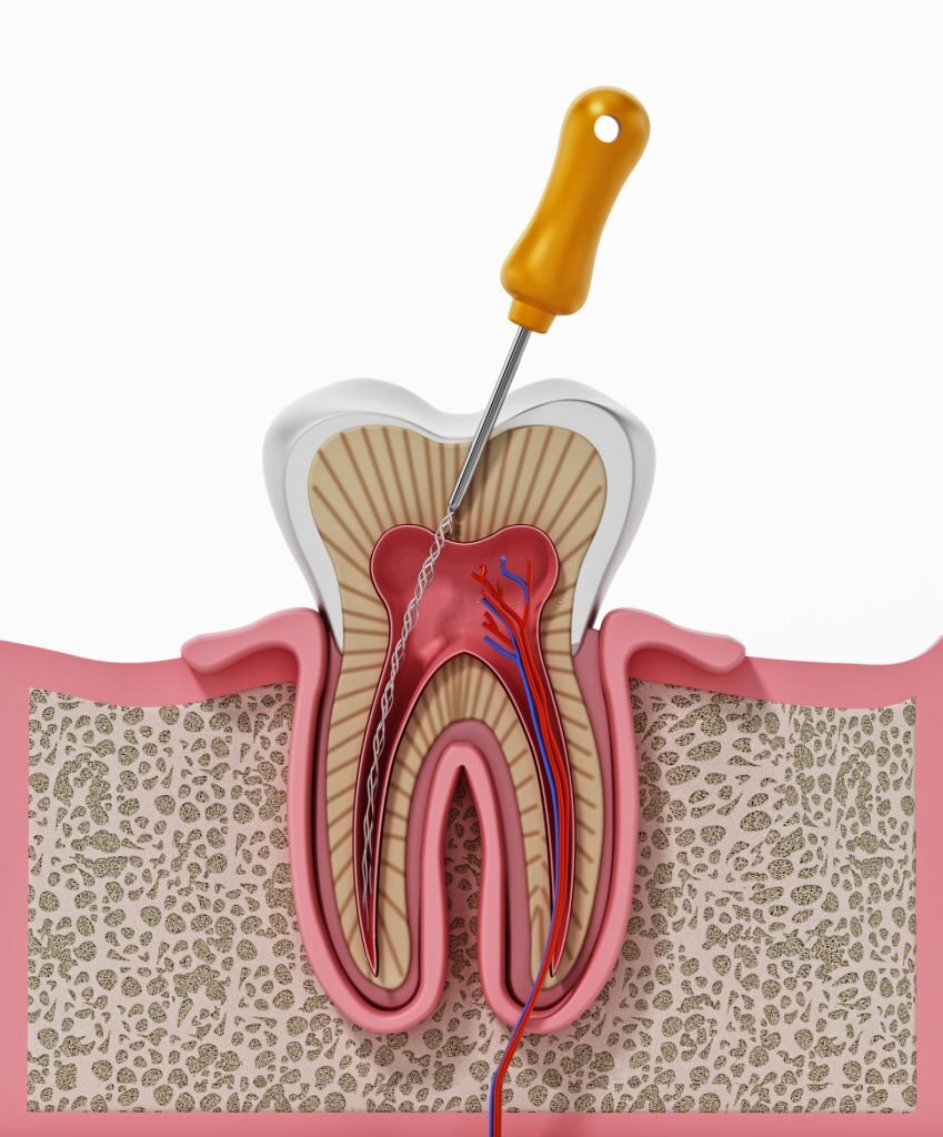 Can I Use Electric Toothbrush After Root Canal