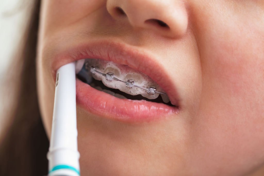 Is it safe to use an electric toothbrush with braces?