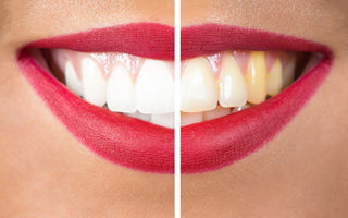 Nine Causes of Yellow Teeth and How to Avoid Them