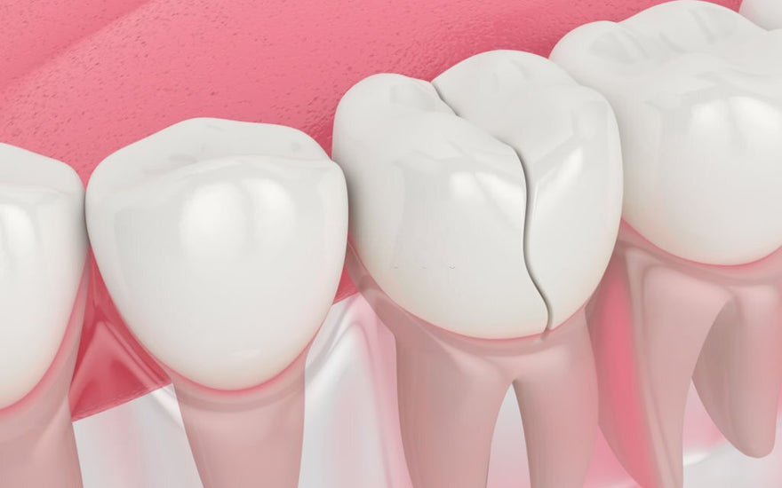 How to Fix a Cracked Tooth Naturally?